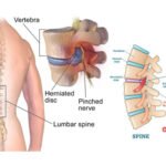 Fisioterapi Saraf Kejepit PIK