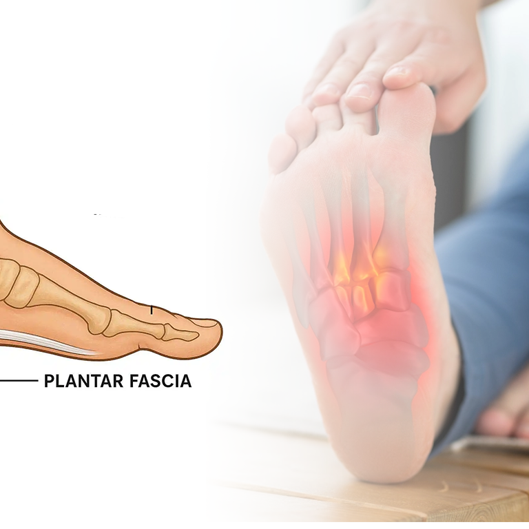 fisioterapi plantar fasciitis PIK